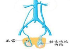 男人精子不液化怎么办