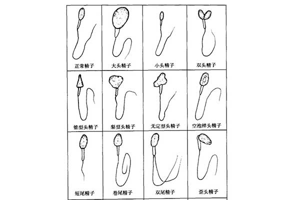 精子畸形.jpg
